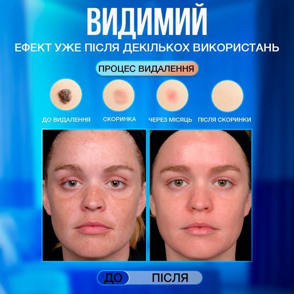 Косметологічний прилад VLVEE для догляду за шкірою обличчя та тіла (плазмова ручка) VLV-5163 фото